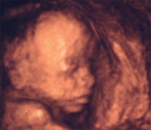 Bestemmelse af barnets køn ved hjælp af ultralyd, så vidt det er korrekt