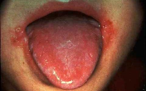Symptomer og tegn på stomatitis hos børn