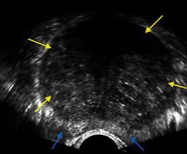 Transrectal ultralyd af prostata: beskrivelse, forberedelse og anbefalinger